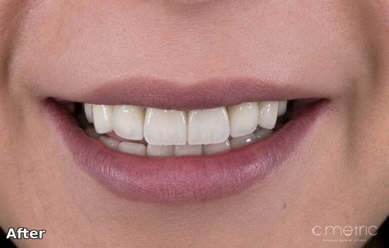 Anterior Crowns - After