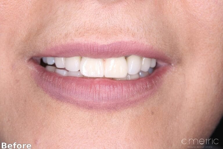 Anterior Crowns - Before