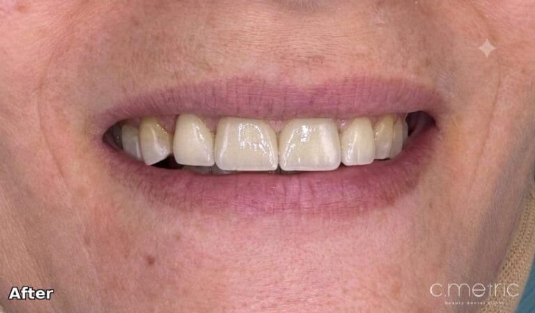 Zirconia Crowns - After