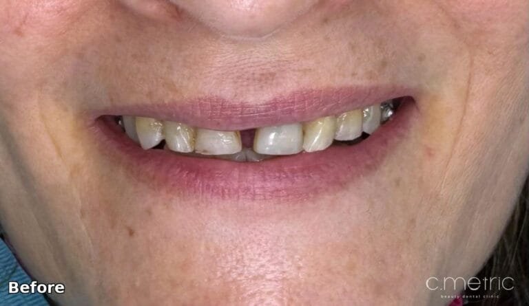 Zirconia Crowns - Before
