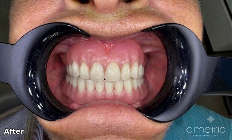 Full-Mouth Rehabilitation - After