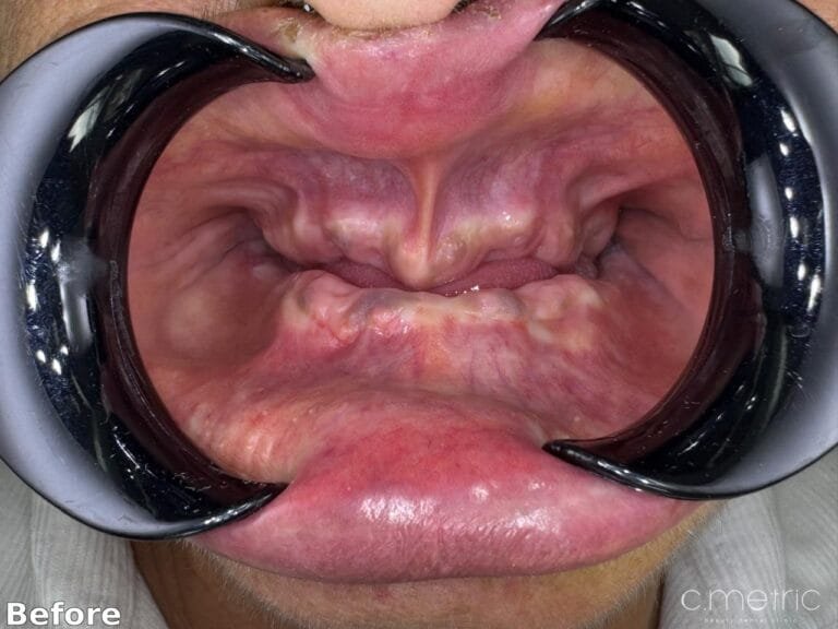 Full-Mouth Rehabilitation - Before